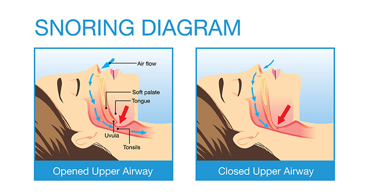 anti snoring devices