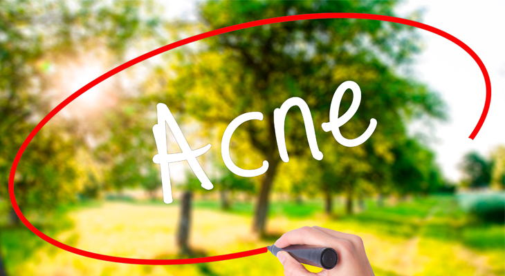 acne on chin