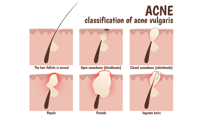 blackhead removal