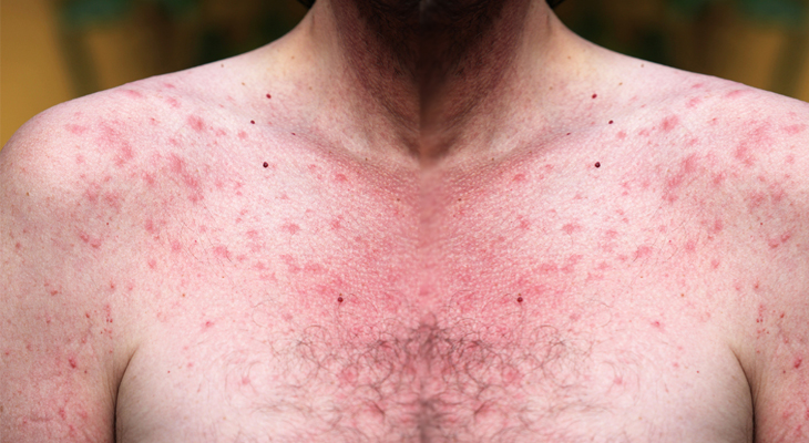 chest acne