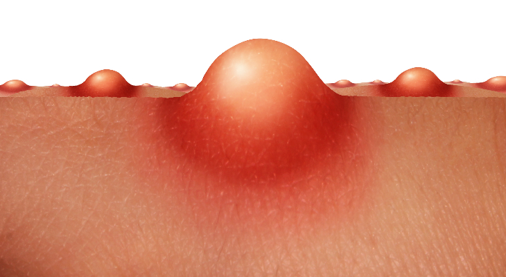 how to get rid of whiteheads