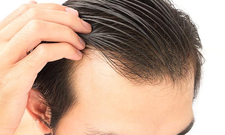 nizoral hair loss