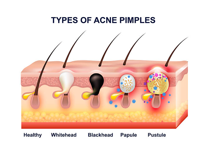 Tips Learn About the Types & Treatments