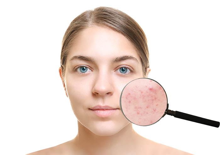 A guide to laser acne scar removal