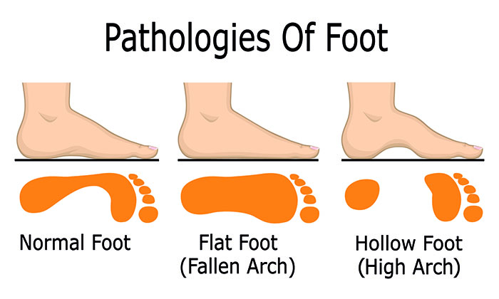 best arch support for plantar fasciitis