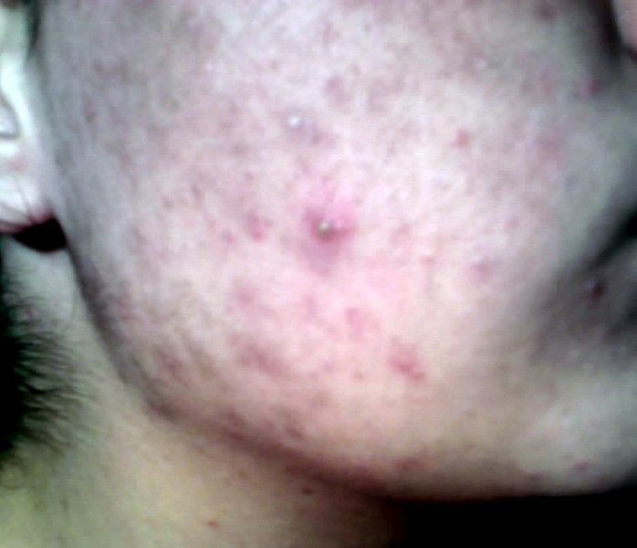 Laser Acne - Acne Skin