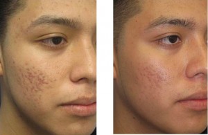 Laser Acne - Before & After