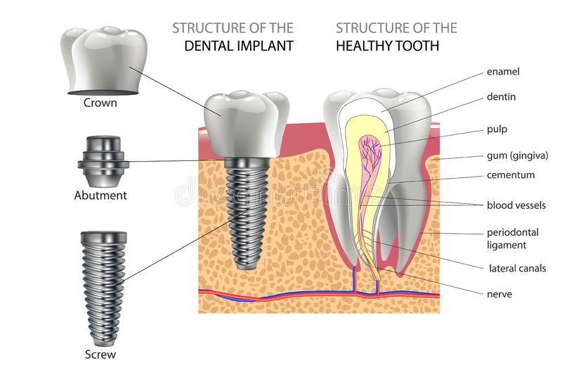 dental implants