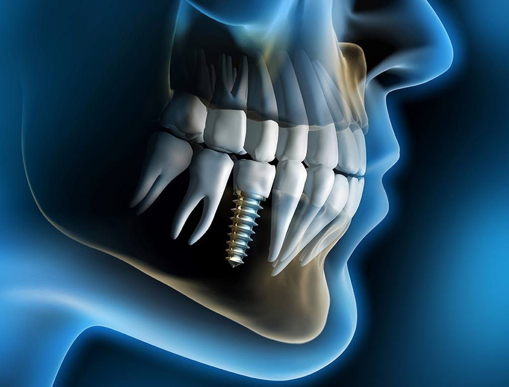 implant dentistry and dental implant